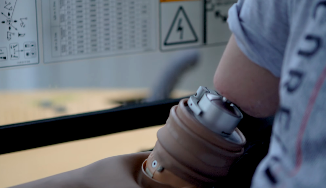 Living in northen Sweden with bionic prosthesis – omslagsbild